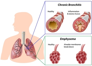 CPB - Chronic Pulminary Bronchitis