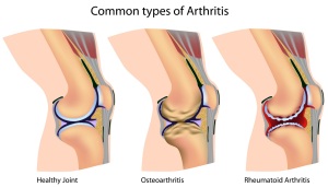 Arthritis Knee Diagram