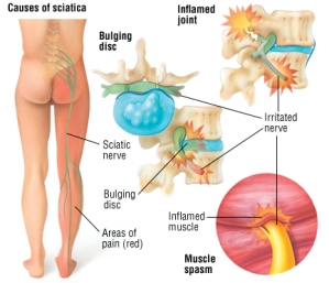 Sciatica Pain Causes