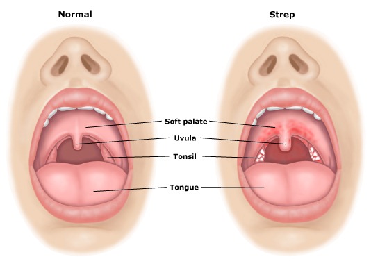 Babys Swollen Throat Virus 58