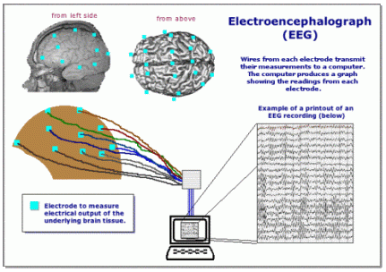EEG Epilepsy