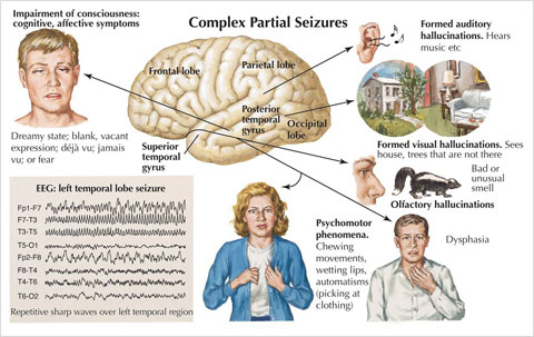 Complex partial seizure symptoms include chewing movements, wetting 