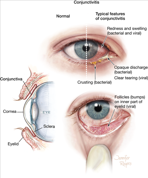 Pink Eye - Pictures, Symptoms, Treatment, Contagious ...